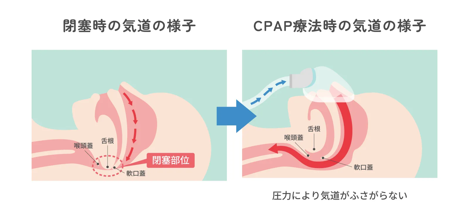 CPAP療法の図解